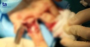 phau-thuat-cap-cuu-ban-tay-dap-nat-thumb